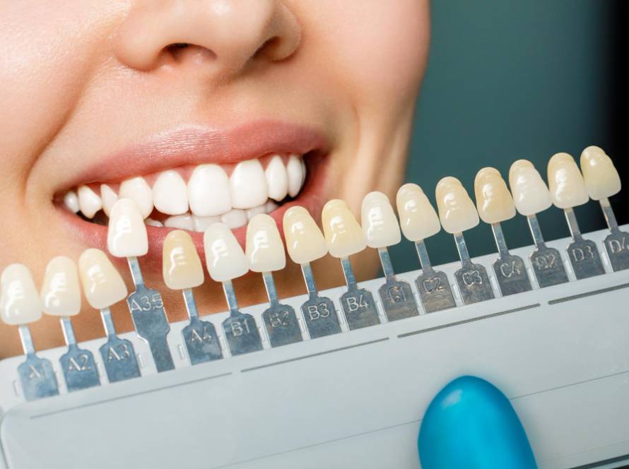 How Much Does Professional Teeth Whitening Cost?