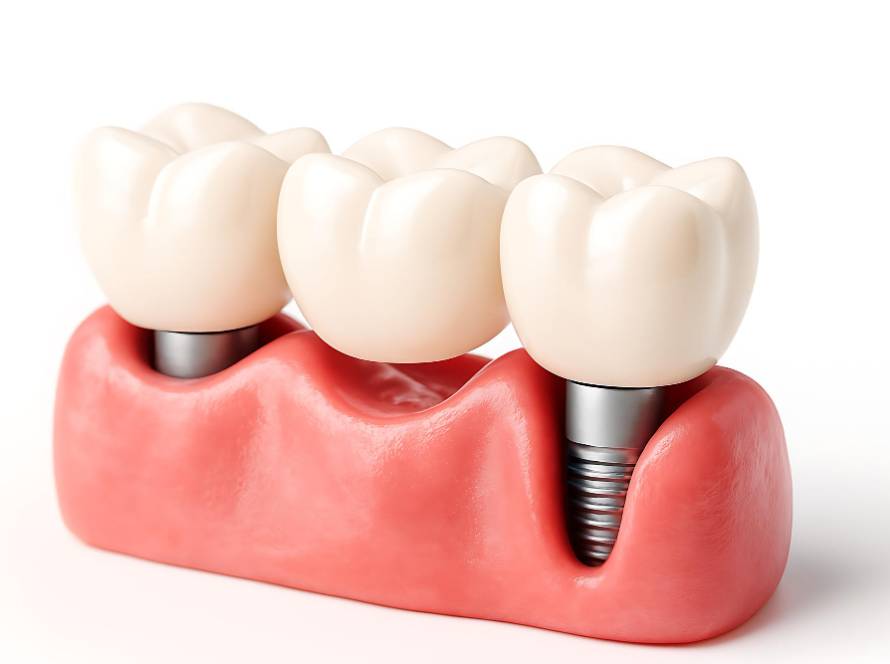 How To Choose The Best Material For Dental Implant Crowns