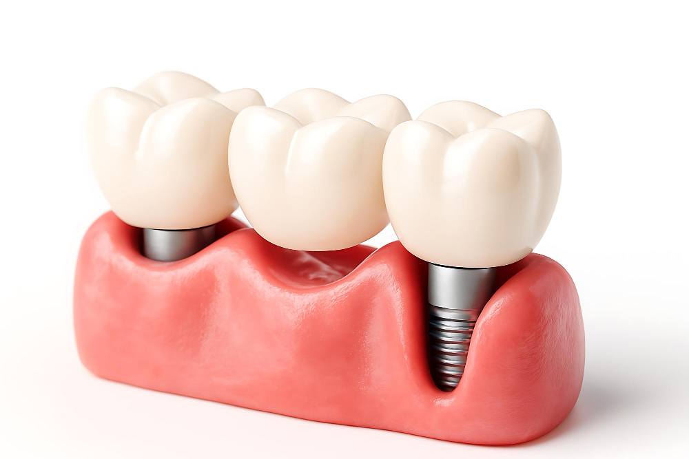 How To Choose The Best Material For Dental Implant Crowns