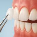 Are Veneers Really Worth Your Time?