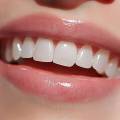 Composite Vs. Porcelain Veneers: Which Is Better For You?