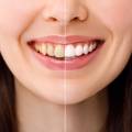 How Long Does Teeth Whitening Usually Last?
