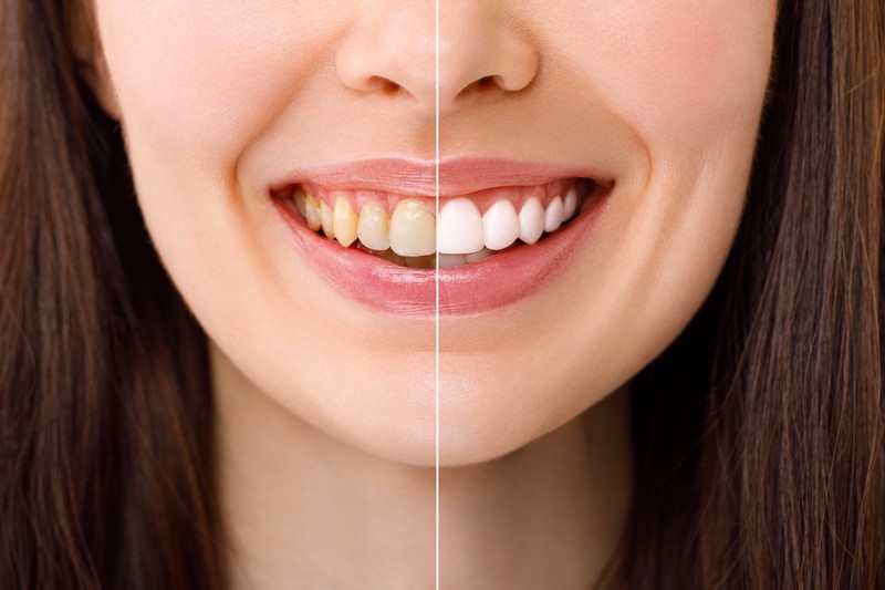 How Long Does Teeth Whitening Usually Last_