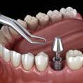 What Are The Different Types Of Dental Implants?