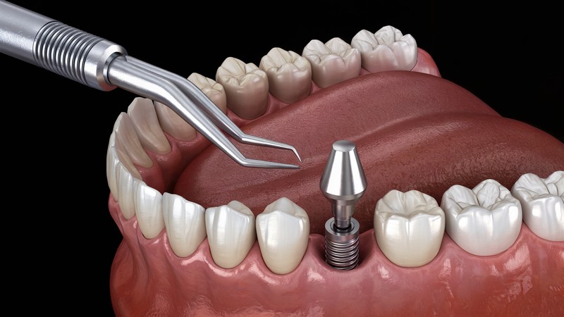 What Are The Different Types Of Dental Implants_
